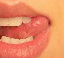Zašto perleches pojavljuju na usnama?