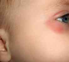 Zašto dijete može biti crveno ispod očiju