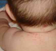 Sudamen na vratu djeteta