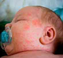 Osip od vrućine u novorođenčeta na licu