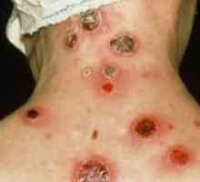 Simptomi sifilisa kod žena