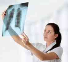 Prevencija tuberkuloze