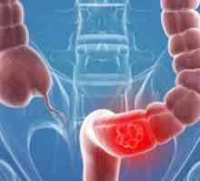 Rak debelog crijeva sigmoidalne - prvi simptomi