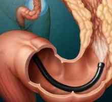 Rak debelog crijeva - Simptomi