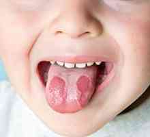 Stomatitis u djece
