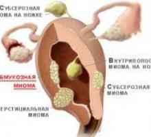 Fibroidi maternice submukozna - liječenje