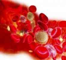 Trombocitopenija - uzroci i liječenje