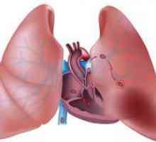 Plućne embolije - simptoma, liječenje