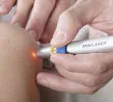 Uklanjanje papiloma laser - učinci