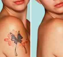 Uklanjanje tetovaža laserom