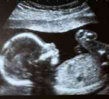 Ultrazvuk - 22 tjedana trudna