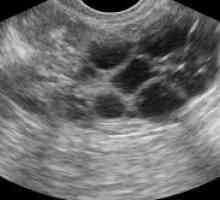 Ultrazvuk jajnika