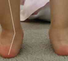 Valgus stopala deformacija kod djece