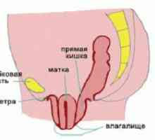 Prolapsa maternice - Simptomi