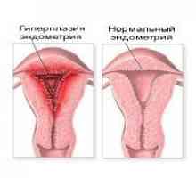 Žljezdane hiperplazije endometrija