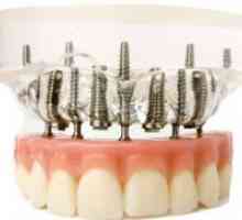 Zubni implantati
