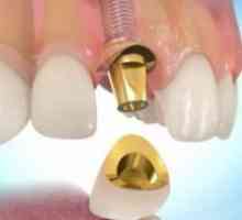 Zubnih kruna