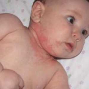 Alergija kod beba - kako liječiti?