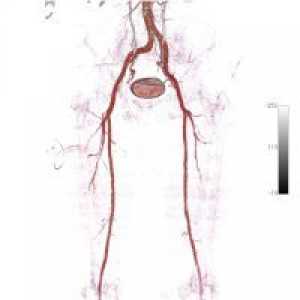 Angiografija donjih ekstremiteta
