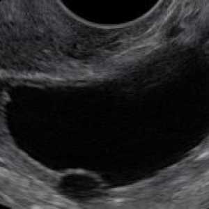 Anehogennoe formacija u jajniku