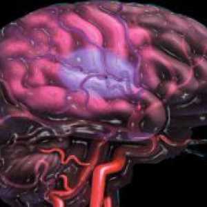 Cerebralna ateroskleroza - Simptomi