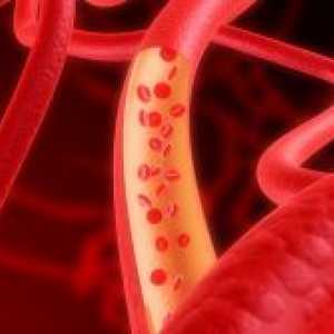 Arterioskleroza