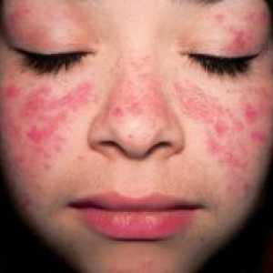 Atopijski dermatitis - Simptomi