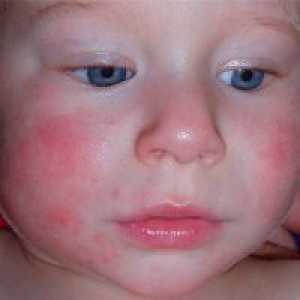 Atopijski dermatitis u djece - liječenje