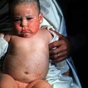 Infekcije citomegalovirusom u djece - liječenje
