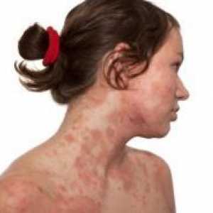 Dermatitis na licu