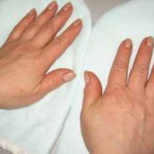 Dermatitis - simptomi i tretman