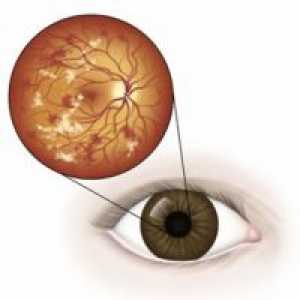 Dijabetička retinopatija