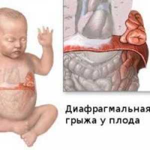 Dijafragmalna kila u novorođenčadi