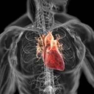 Dilatacijske kardiomiopatije