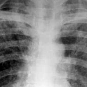 Diseminirane tuberkuloze