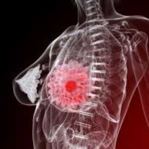 Benigni tumor dojke - liječenje