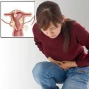 Fibroidi maternice