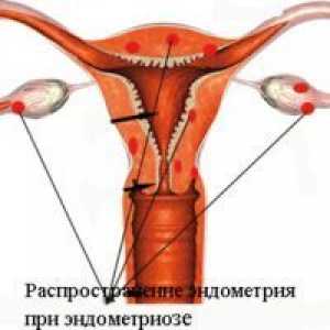 Genitalija endometrioza