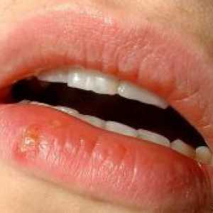 Herpes na usnama djeteta