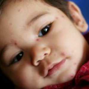 Herpes kod djece - liječenje