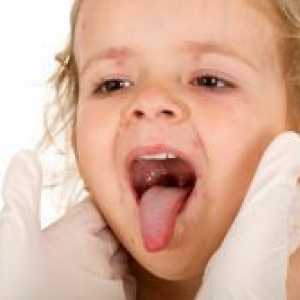 Herpangina u djece - liječenje