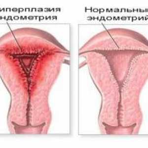 Hiperplazije endometrija i trudnoća