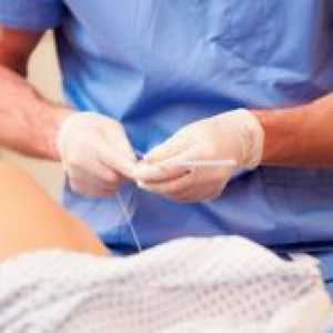 Hiperstimulacije jajnika - Simptomi