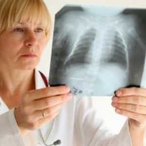 Kronični opstruktivni bronhitis