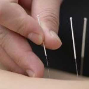 Akupunktura u osteochondrosis