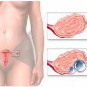 Endometrioid jajnika cista - liječenje