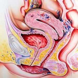 Crijevna Endometrioza - Simptomi