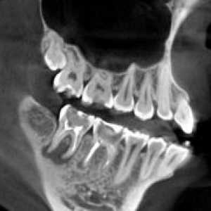 Kompjuterizirana tomografija zubi
