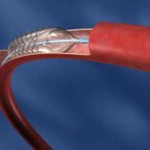 Presađivanja premosnice koronarnih arterija