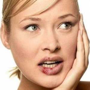 Liječenje herpesa na usnama: brzo, efikasno i jeftino